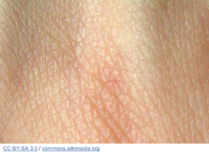 The Pressure is On! Prevent Pressure Injuries and Promote Skin Health