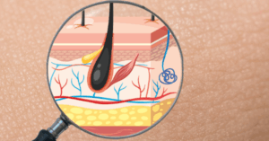 The Pressure is On: The Fight Against Pressure Injuries